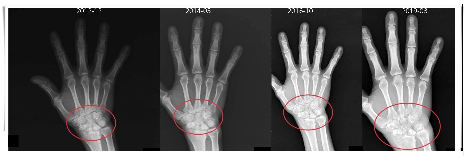 廚師誤解類風濕關節炎:不痛不代表沒事,醫師提醒定期檢查重要性