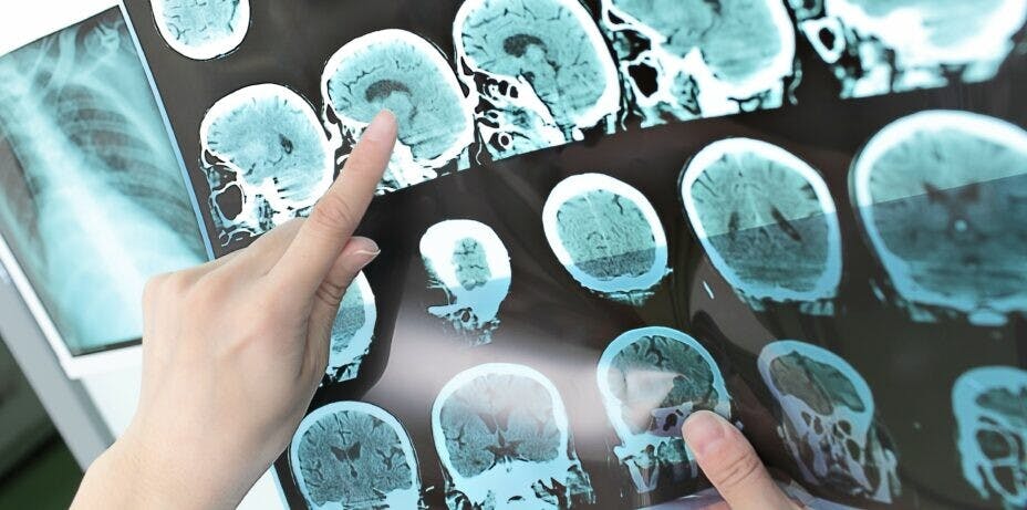 中風不止是全球第二大死因，最可怕的是會引致成人永久傷殘及認知障礙。（Shutterstock）