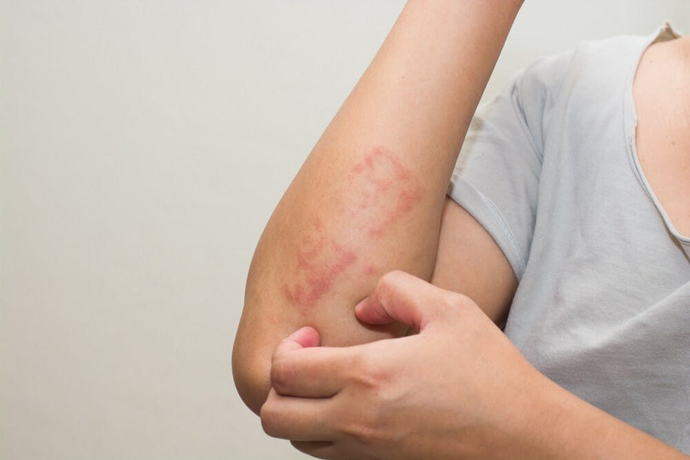 避免皮膚敏感不是要戒口，而是不要過量吃。（Shutterstock）