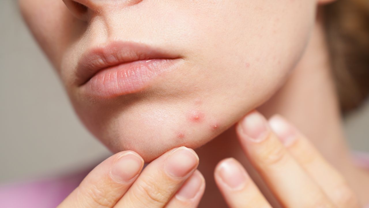 對於許多成年女性而言，痘痘的來去，往往與體內的潮汐緊密相連。（Shutterstock）