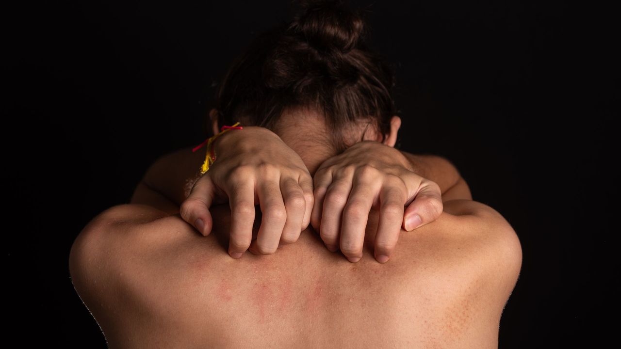 皰疹令病人疼痛與瘙癢交織。（Shutterstock）