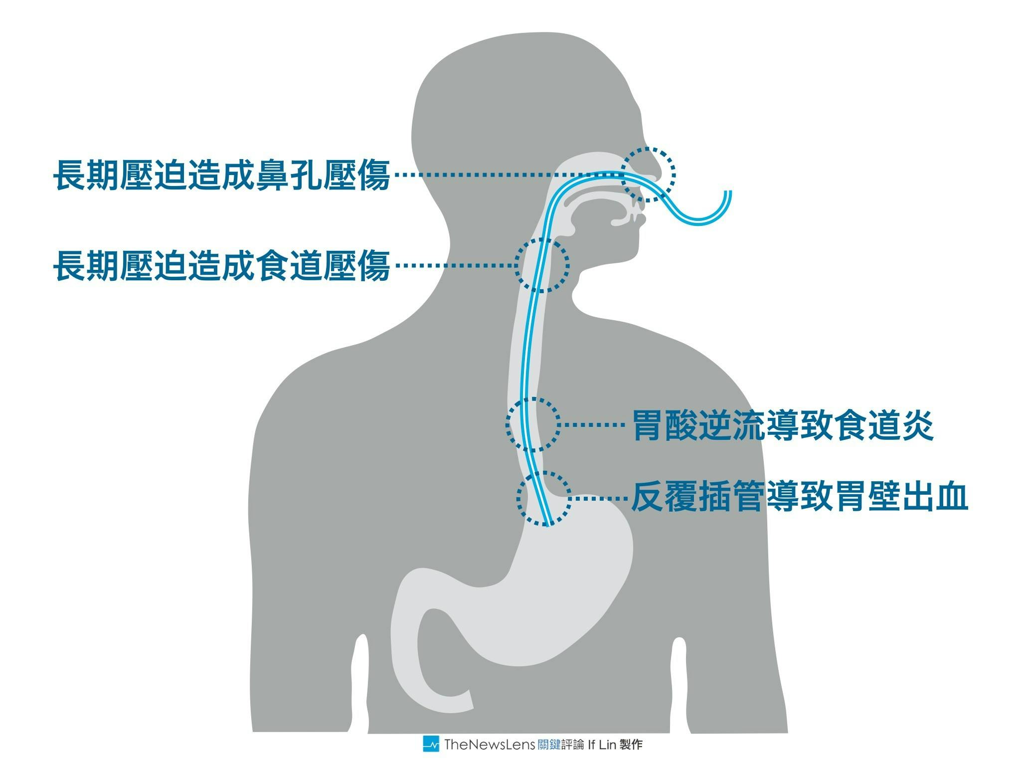 【圖表】鼻胃管還是胃造口?有品質的長照生活另種思考 - TNL The News Lens 關鍵評論網