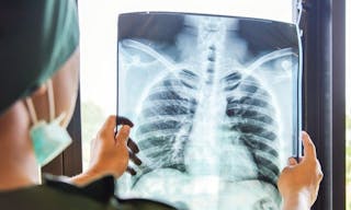 1 lung 胸部X光 肺癌