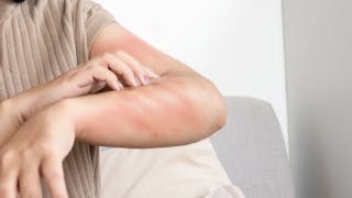 濕疹蕁麻疹並發