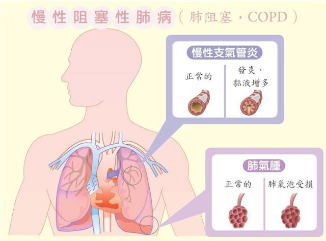 肺阻塞，是一種常見的慢性呼吸道反覆發炎造成的下呼吸道疾病；會導致呼吸道阻塞，無法順暢呼吸，會出現咳、痰等症狀；肺泡發炎肺氣腫，就逐漸出現喘的症狀。（圖片引自花蓮慈院新書《年過四十，打造熟齡A+健康力》）