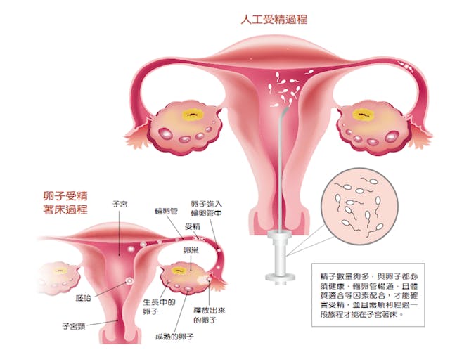 陳寶珠醫師說，須有健康的精子和卵子；精子數量要足夠，輸卵管通暢，母體健康，卵子才能確實受精；且需要一段旅程，受精卵才能在子宮着床。