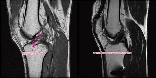 病人手術前（左）及完成後3個月（右）的前十字韌帶磁振造影檢查（MRI）影像。