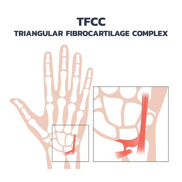 TFCC作為手腕的避震器，是一個非常容易受傷的部位。（Shutterstock）