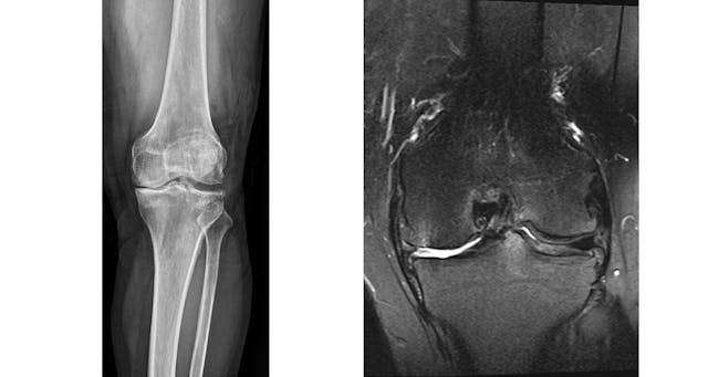 從X光（左圖）或磁振造影（MRI，右圖）檢查，黃先生的膝關節均退化得很嚴重。