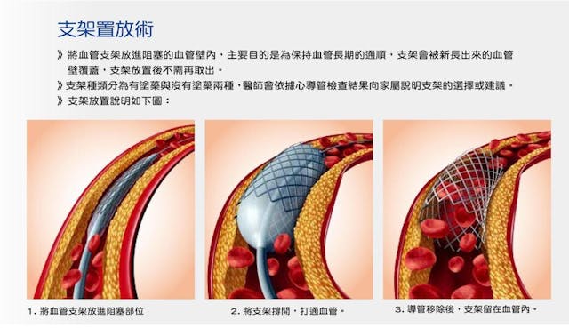 置放冠狀動脈支架示意圖。