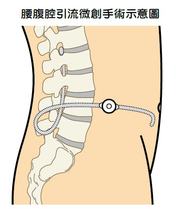腰腹腔引流微創示意圖。