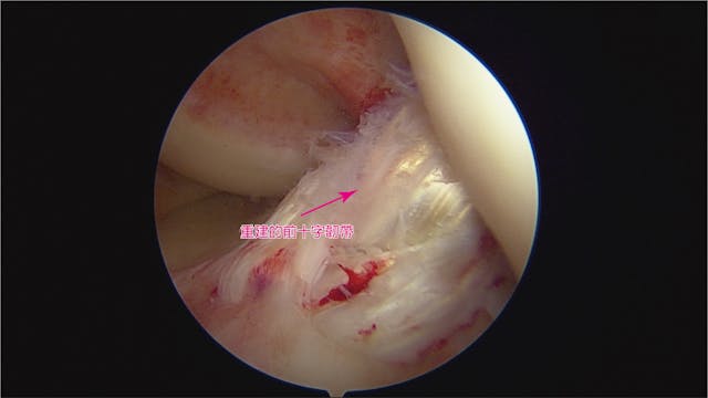 病人手術後3個月的前十字韌帶復原情形。