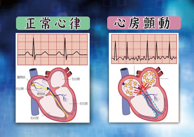 心房顫動與正常心臟示意圖。