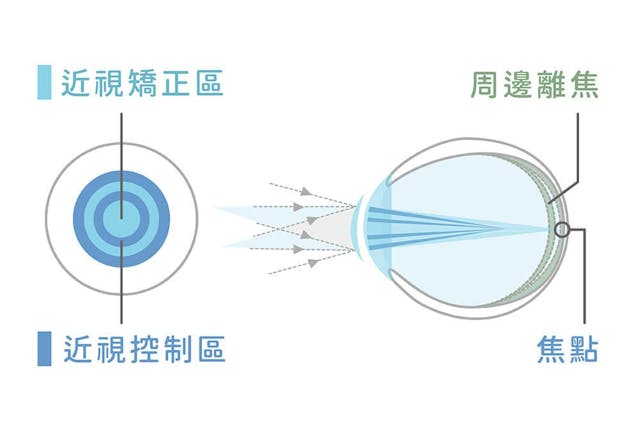 由香港執業眼科視光師協會提供的其中一款近視控制光學鏡片設計。(圖片由受訪者提供)